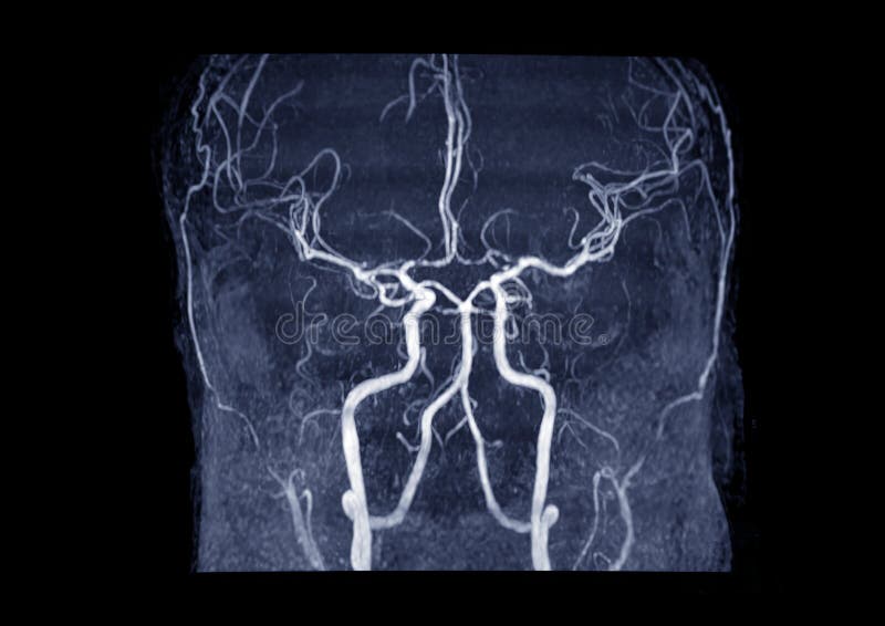 MRA Brain or Magnetic resonance angiography MRA of cerebral artery in the brain.