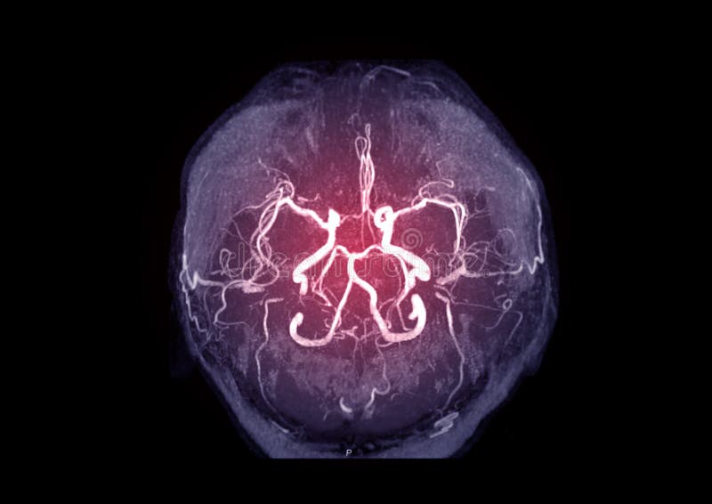 MRA Brain or Magnetic resonance angiography MRA of cerebral artery in the brain.