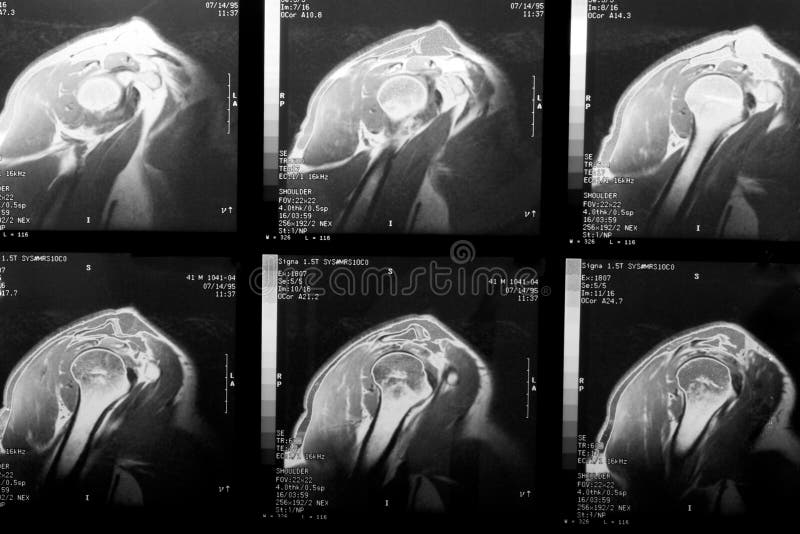 MRI av Rotatormanschetten arkivfoto MRI av Rotatormanschetten arkivfoto