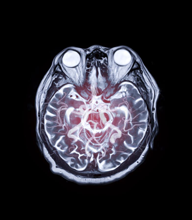 MRI brain Axial  T2 technique  with mra brain mix image.