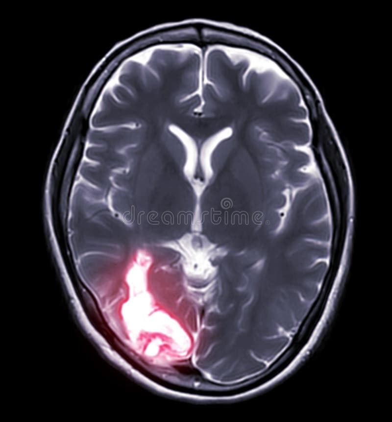 MRI brain Axial T2W view .