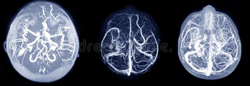 Brain 71. Синус тромбоз на томографии. Тромб синуса головного мозга мрт. Intracranial Midline MRI. МРА.