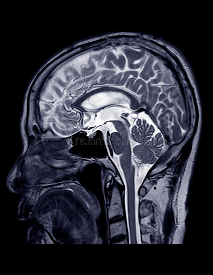 MRI of the brain sagittal plane.