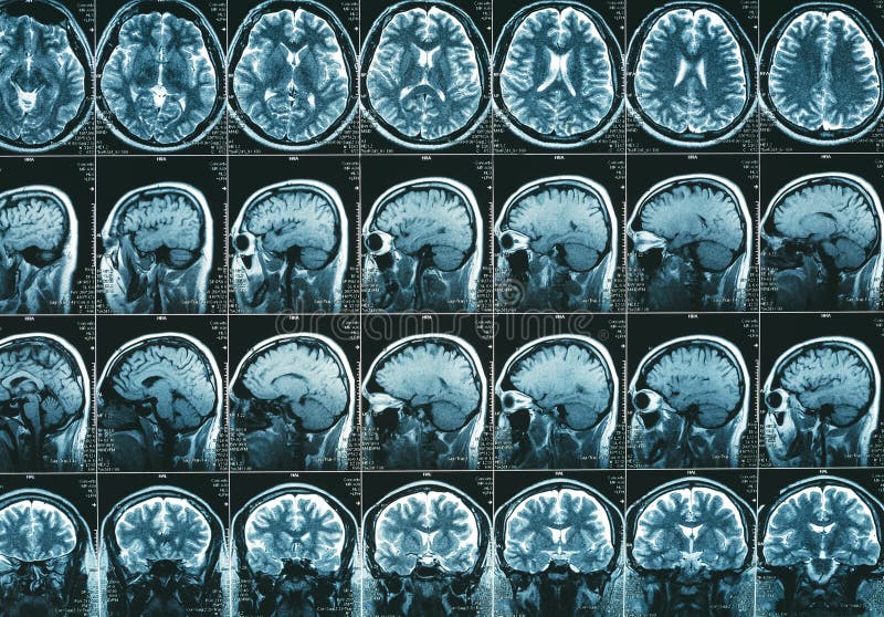 MRI brain scan or magnetic resonance of head image results, neurology concept