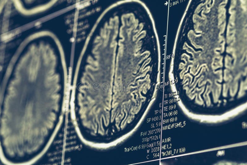 MRI brain scan or x-ray neurology human head skull tomography test