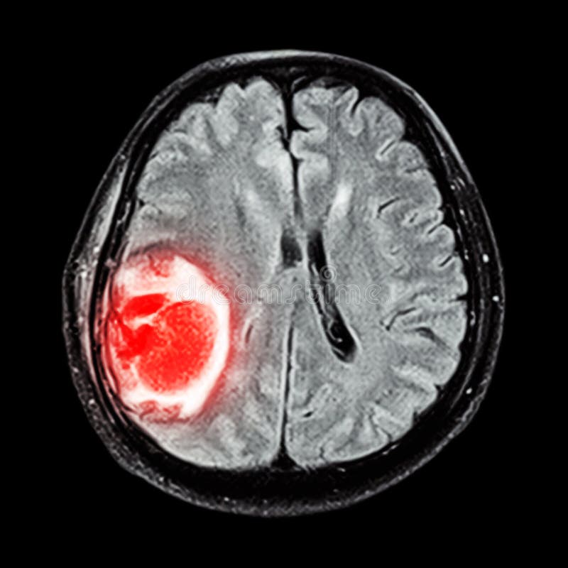 MRI brain : show brain tumor at right parietal lobe of cerebrum