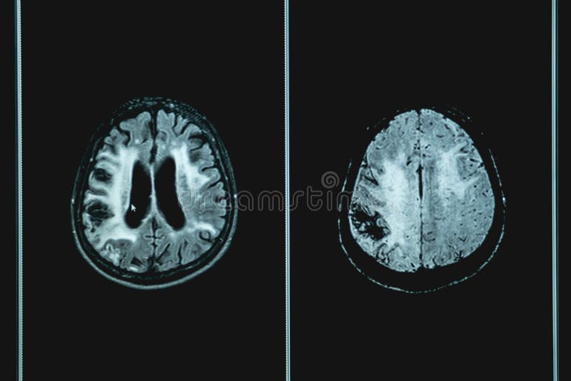 MRI Brian demencja pacjent