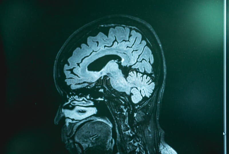 MRI Brian of Dementia Patient Stock Photo - Image of imaging, science