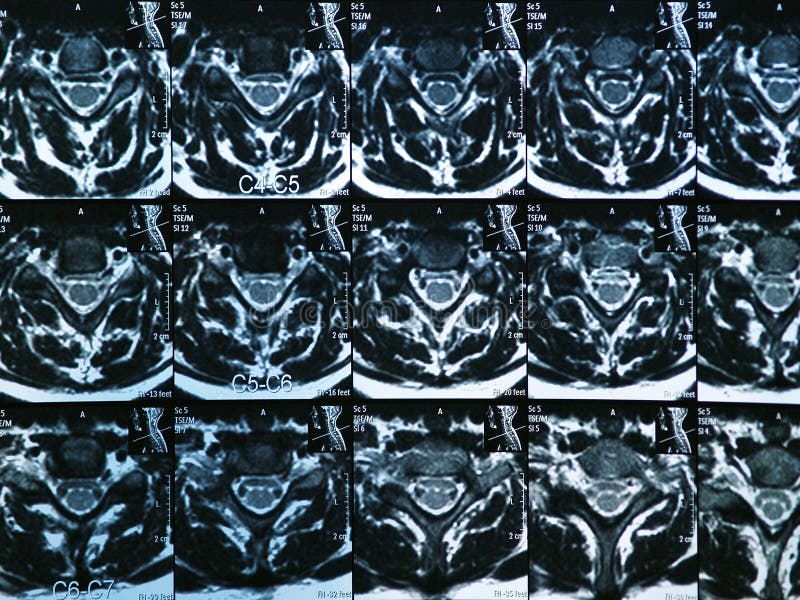 MRI C-spine. Health, illness.