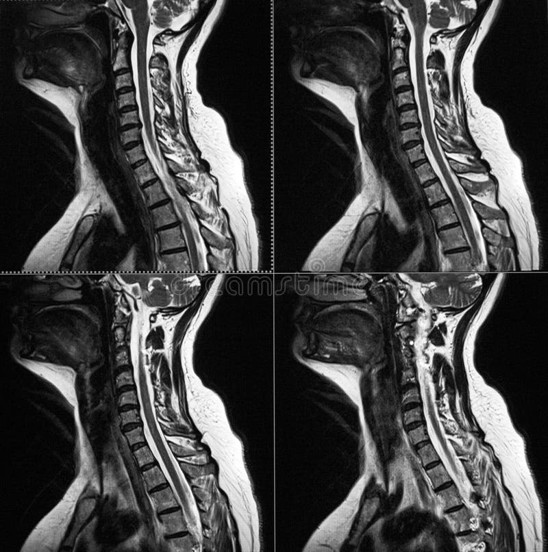 MR image of cervical spine, all segments - diagnostic radiology - showing disk herniation (C5-C6 level). Magnetic resonance, several sagittal images searching for disk disease. MR image of cervical spine, all segments - diagnostic radiology - showing disk herniation (C5-C6 level). Magnetic resonance, several sagittal images searching for disk disease.