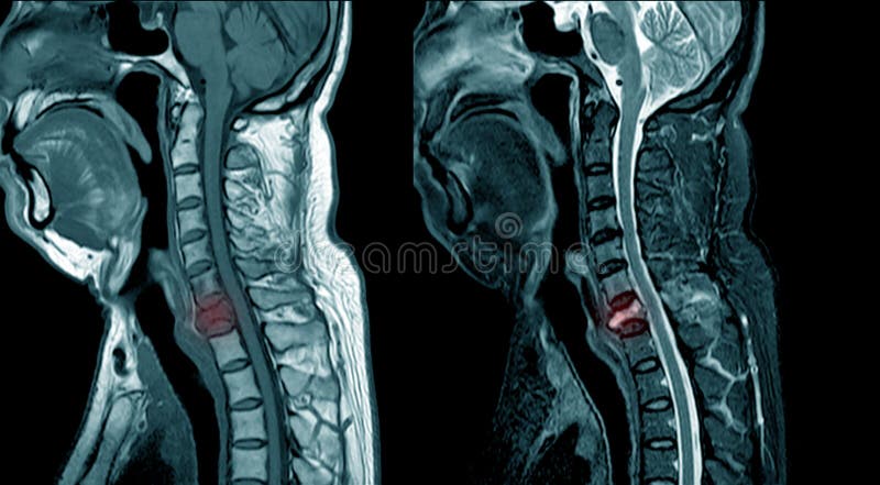 MRI of cervical spine spine soft tissue mass. royalty free stock photography