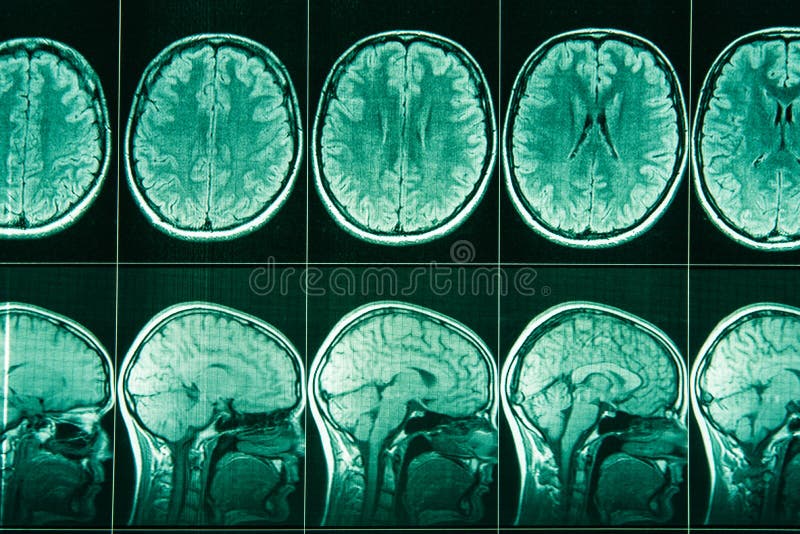 mri con contraste de la cabeza mri con contraste de la cabeza