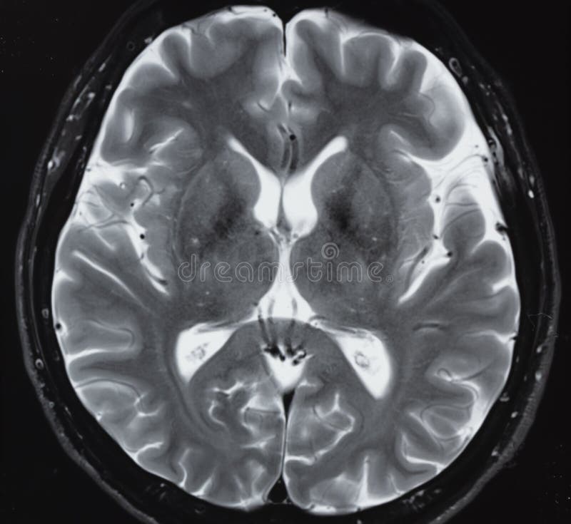 MRI der normalen Anatomie des menschlichen Gehirns lizenzfreies stockbild MRI der normalen Anatomie des menschlichen Gehirns lizenzfreies stockbild