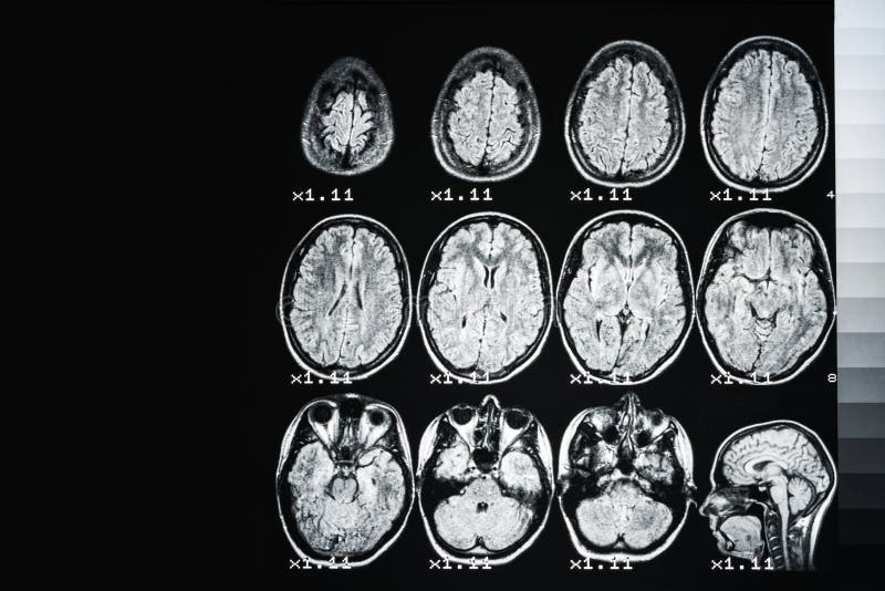 MRI des Gehirns einer gesunden Person auf einem schwarzen Hintergrund mit grauer Hintergrundbeleuchtung lizenzfreie stockbilder MRI des Gehirns einer gesunden Person auf einem schwarzen Hintergrund mit grauer Hintergrundbeleuchtung lizenzfreie stockbilder
