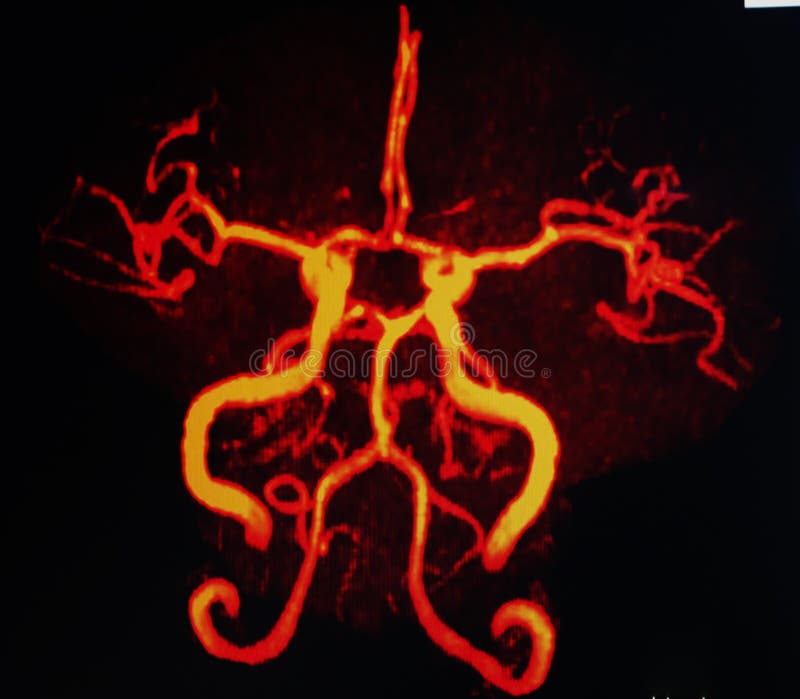 Mri des navires de cou et de cerveau image libre de droits Mri des navires de cou et de cerveau image libre de droits