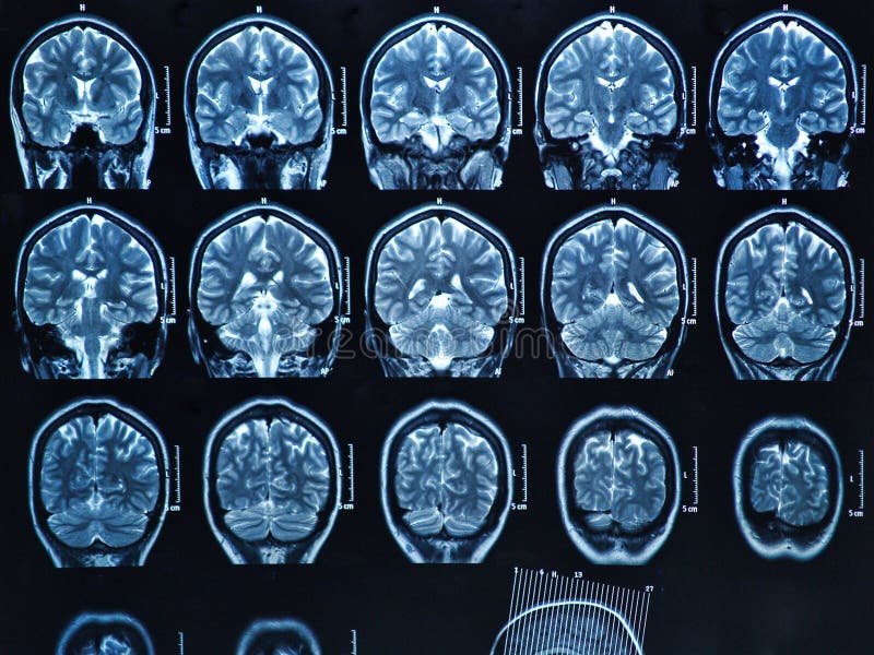 MRI-hjärnbildläsning royaltyfri fotografi MRI-hjärnbildläsning royaltyfri fotografi
