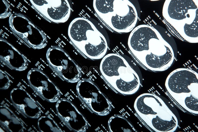 X-tay MRI of human brain