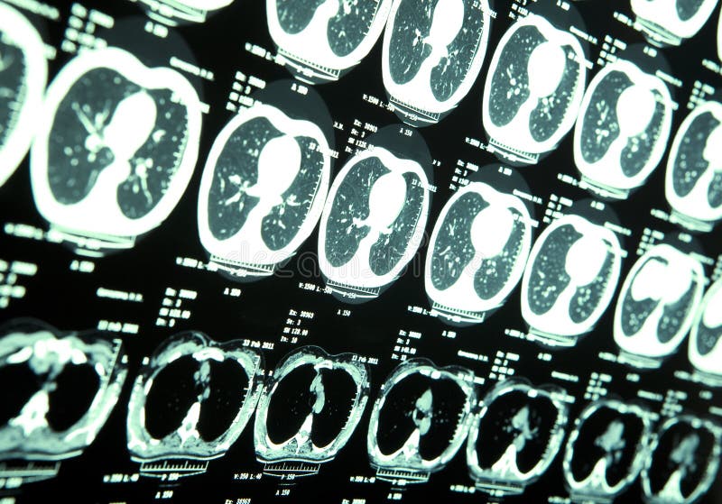 X-tay MRI of human brain