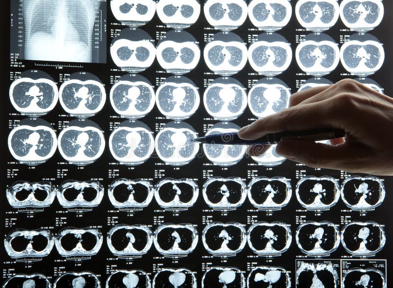 X-tay MRI of human brain