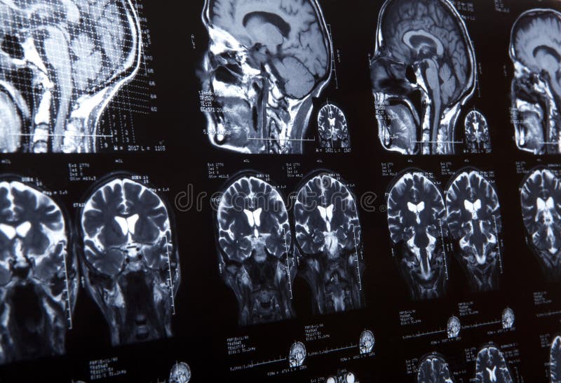 MRI of human brain stock photography