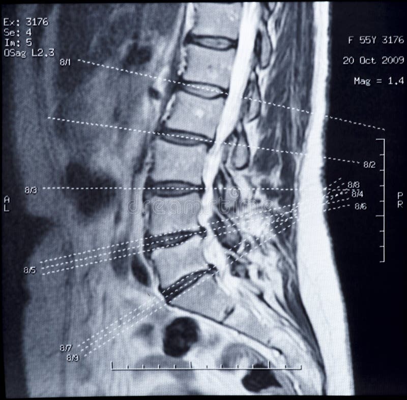 MRI image of human spine