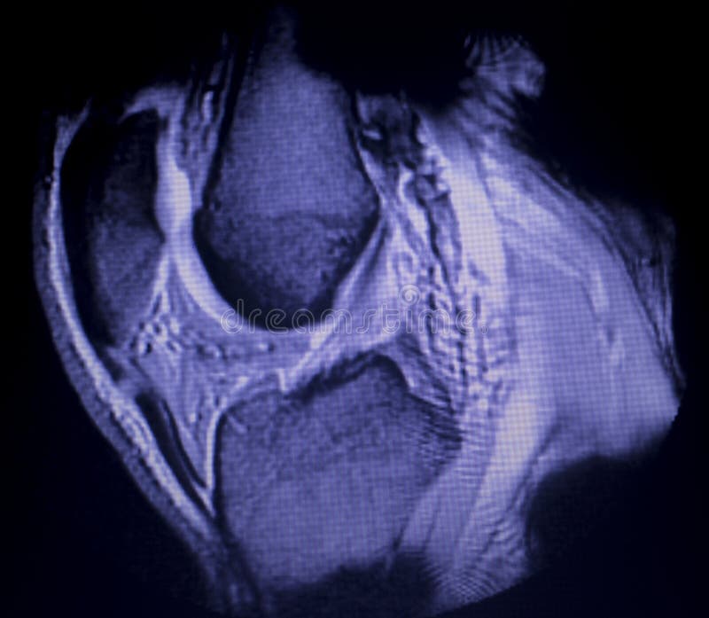 MRI Knee Meniscus Tear Scan Stock Photo - Image of meniscus, anatomy ...