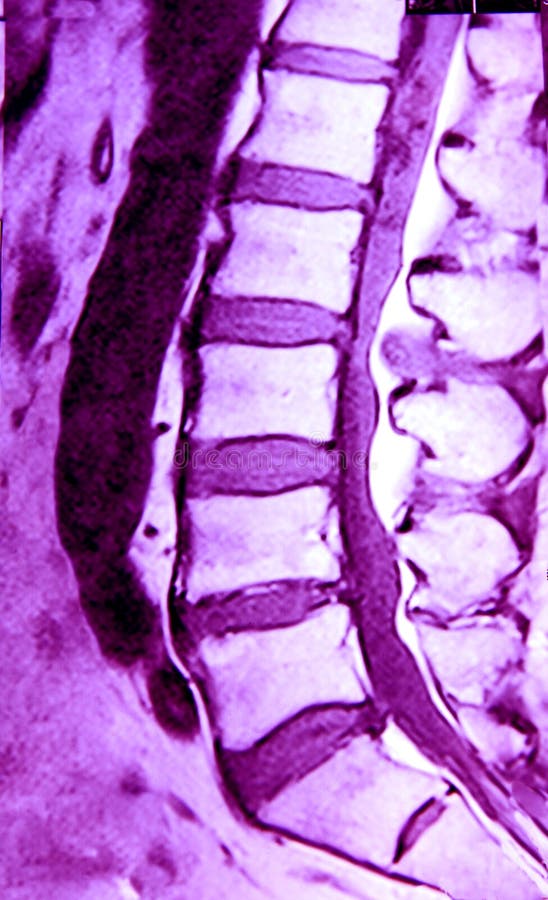 Magnetic resonance image of lumbar spine, single level, purple. Magnetic resonance image of lumbar spine, single level, purple