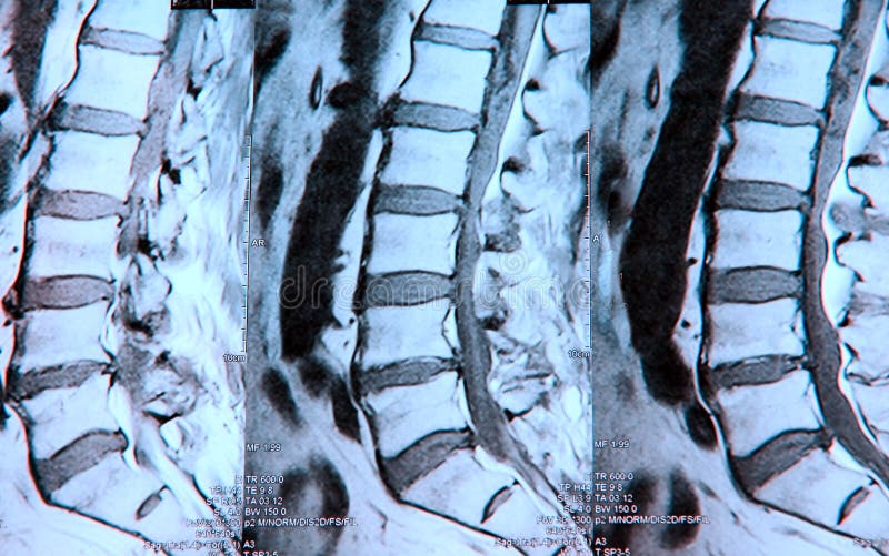 MR image of lumbar spine, several levels. MR image of lumbar spine, several levels