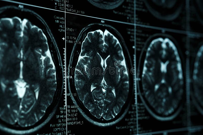 MRI or magnetic resonance image of head and brain scan. Close up view with perspective