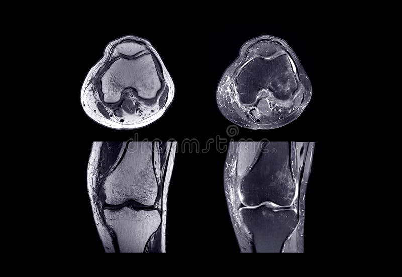 MRI Knee Joint or Resonance Imaging . Stock Image Image of