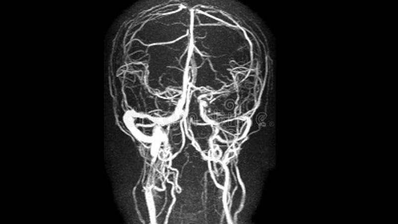 Mri- scan hjärnavbildning för hemorragisk stroke eller ischemisk stroke infarkt medicinskt koncept mot svart bakgrund.
