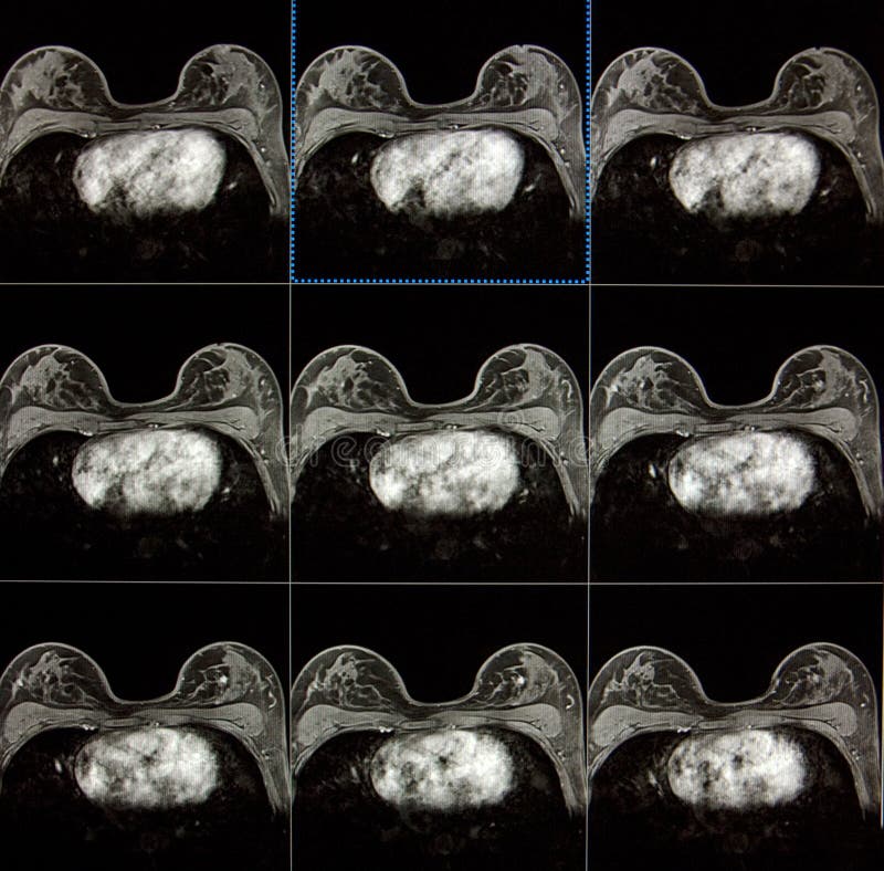Magnetic resonance imaging of breasts (MRI) - searching and detecting breast cancer. Magnetic resonance imaging of breasts (MRI) - searching and detecting breast cancer