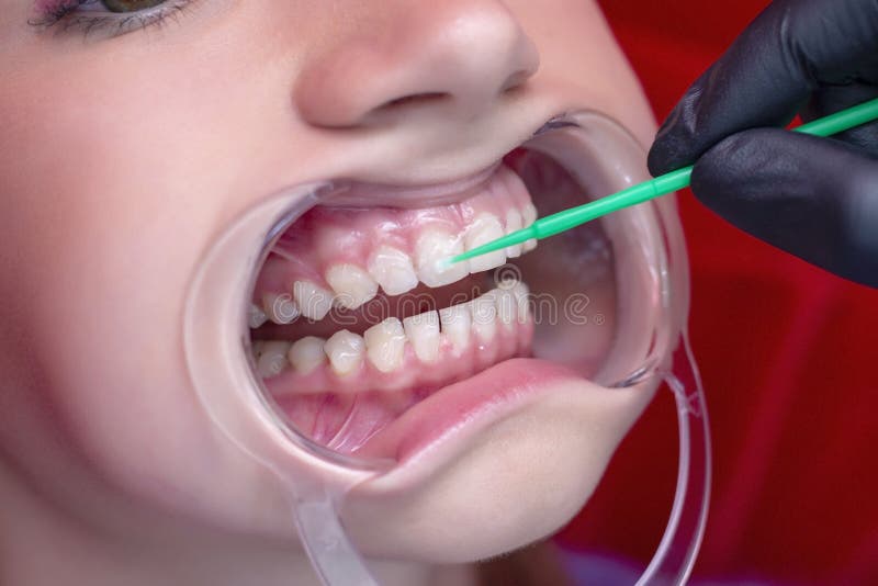 Muchacha en los dientes que blanquea procedimiento con la boca abierta fotos de archivo libres de regalías Muchacha en los dientes que blanquea procedimiento con la boca abierta fotos de archivo libres de regalías