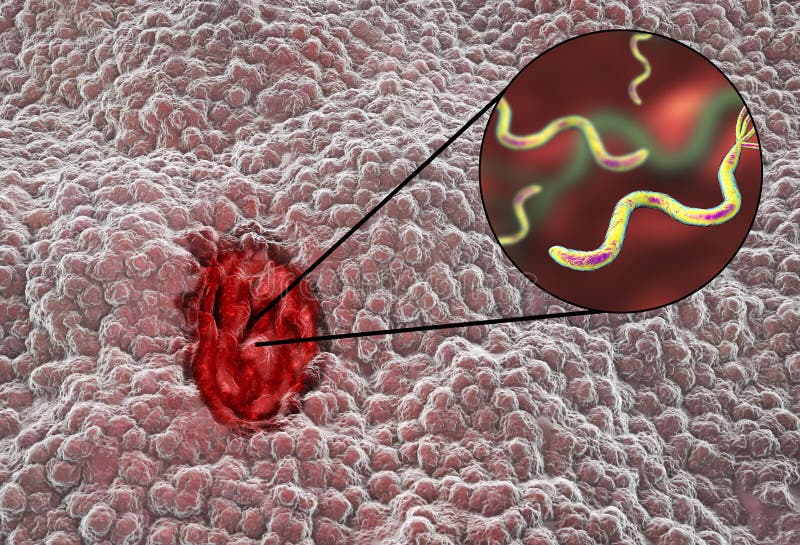 Хеликобактер фото под микроскопом как выглядит пилори Mucosa of Stomach with Peptic Ulcer and Bacterium Helicobacter Pylori Stock Illu
