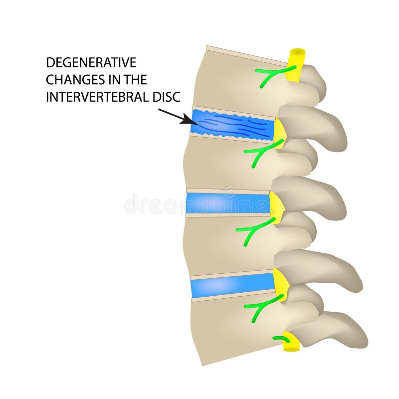 Mudanças degenerativos no disco intervertebral Ilustração do vetor no fundo isolado ilustração stock Mudanças degenerativos no disco intervertebral Ilustração do vetor no fundo isolado ilustração stock