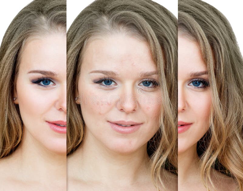 Mujer Con Acné Antes Y Después Del Tratamiento Y Maquillaje. Foto de archivo - Imagen de cara, concepto: 181589200 Mujer Con Acné Antes Y Después Del Tratamiento Y Maquillaje. Foto de archivo - Imagen de cara, concepto: 181589200