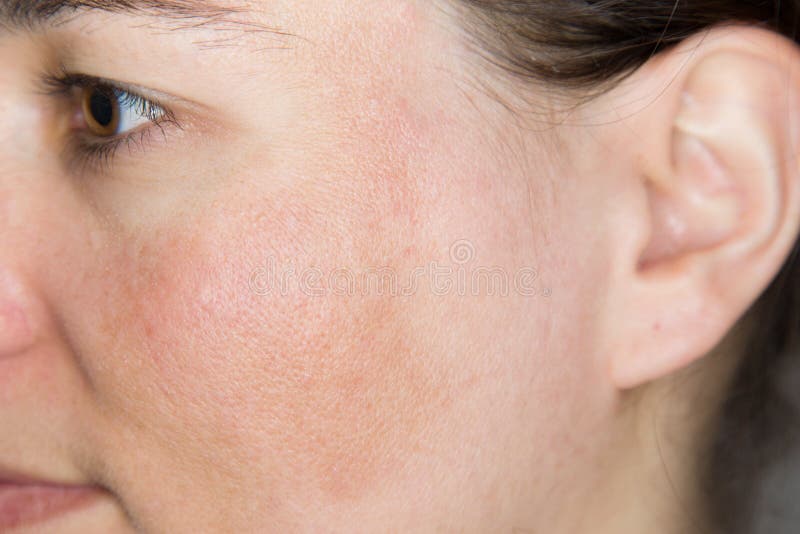 Closeup of a young woman who has pigmented skin on her face. Closeup of a young woman who has pigmented skin on her face