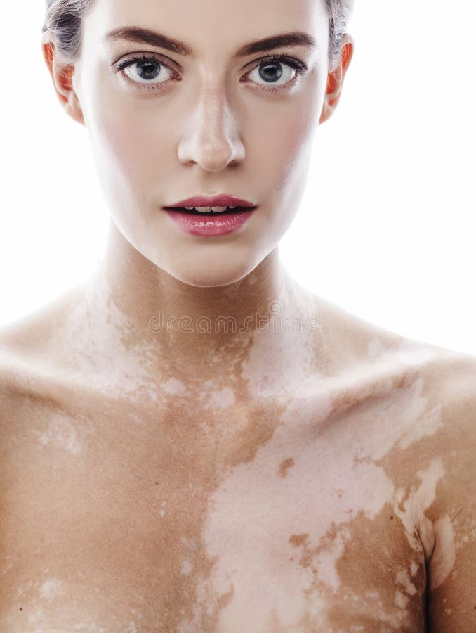 Mujer morena joven hermosa con vitiligo imagen de archivo libre de regalías Mujer morena joven hermosa con vitiligo imagen de archivo libre de regalías