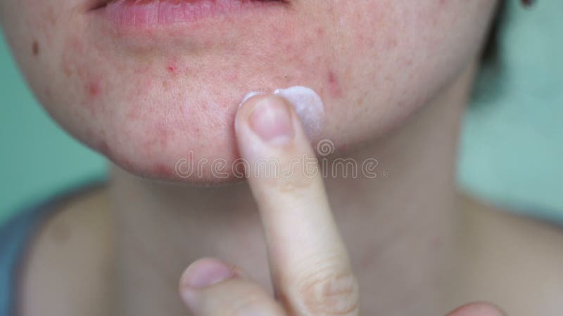 Menina De Scowling Que Aponta Para Sua Acne Com Uma Toalha Em Sua Cabeça.  Conceito Do Cuidado Da Pele Da Mulher, Fotos Da Menina Feia Da Pele Do  Problema No Fundo Branco