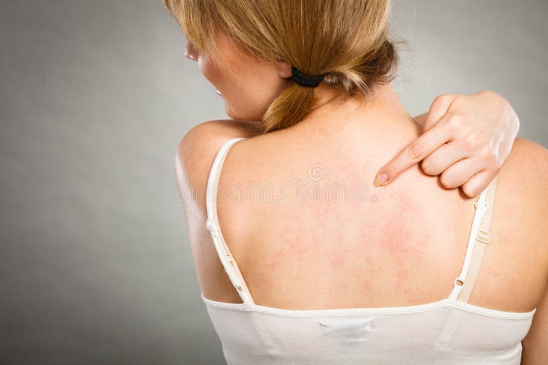 mulher que risca sua parte traseira sarnento com prurido da alergia imagem de stock royalty free mulher que risca sua parte traseira sarnento com prurido da alergia imagem de stock royalty free