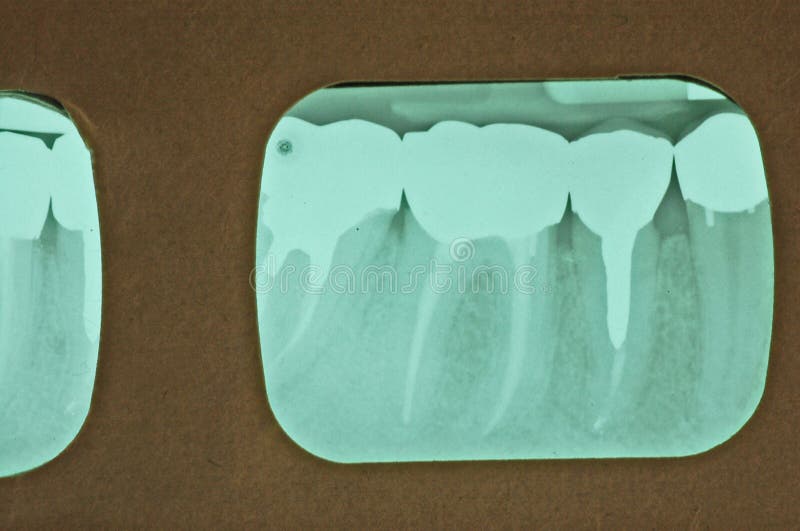 Periapical x-ray od mandibular právo quadrant, zadná časť (nižšie právo zuby v zadnej) ukazuje jeden premolar a dve uloženie stoličiek s root kanály a séria radiopaque (nepretržite nabielo) korún, pravdepodobne niektoré z kovovej zliatiny.