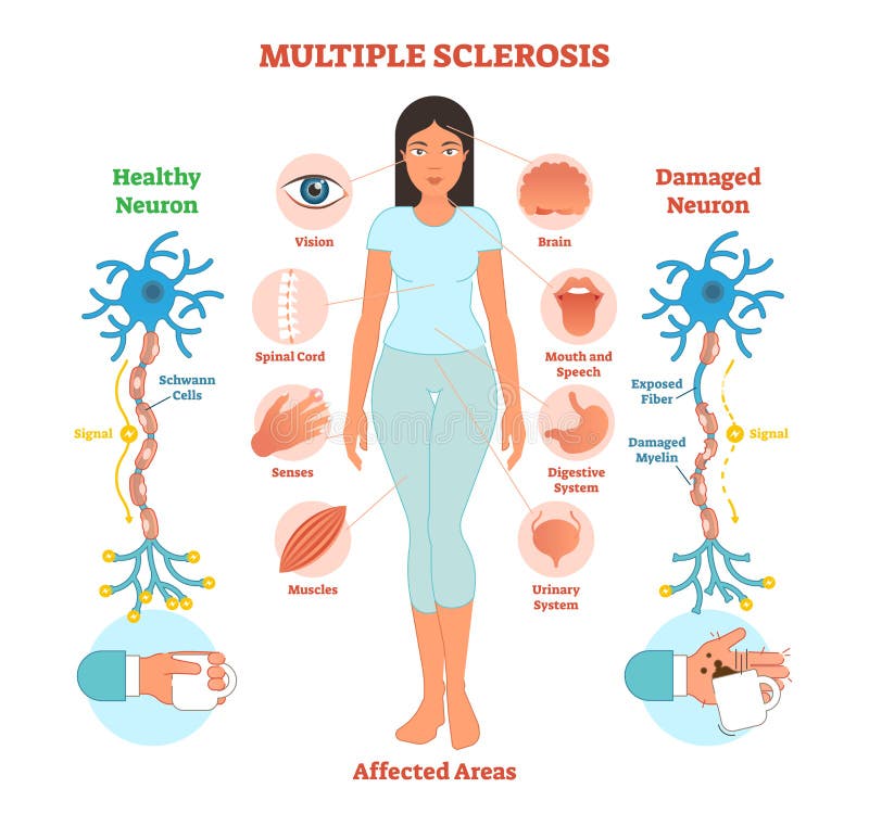 Multiple sclerosis anatomical vector illustration diagram, medical scheme. royalty free illustration Multiple sclerosis anatomical vector illustration diagram, medical scheme. royalty free illustration