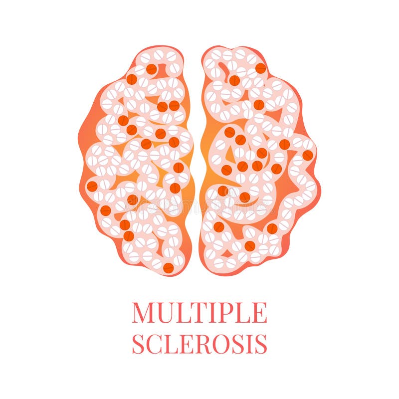 Multiple Sclerosis Poster with Brain Stock Vector - Illustration of