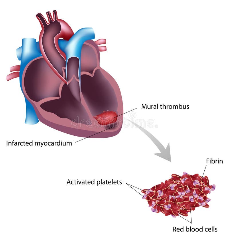 Mural thrombus stock vector. Illustration of endocardium - 27478246