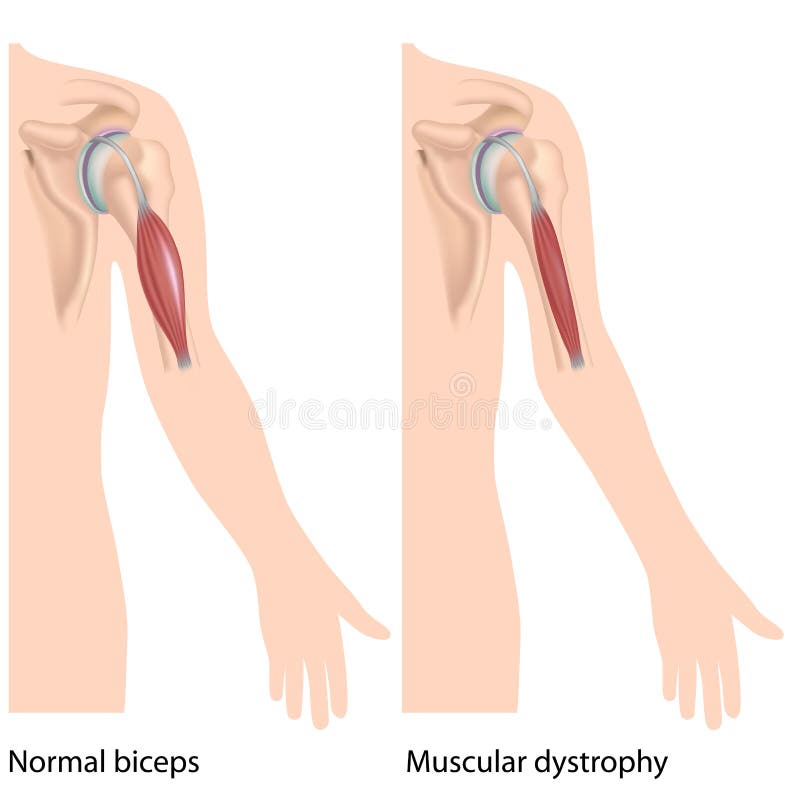 Download Muskulös dystrophy vektor illustrationer. Illustration av system - 27276014