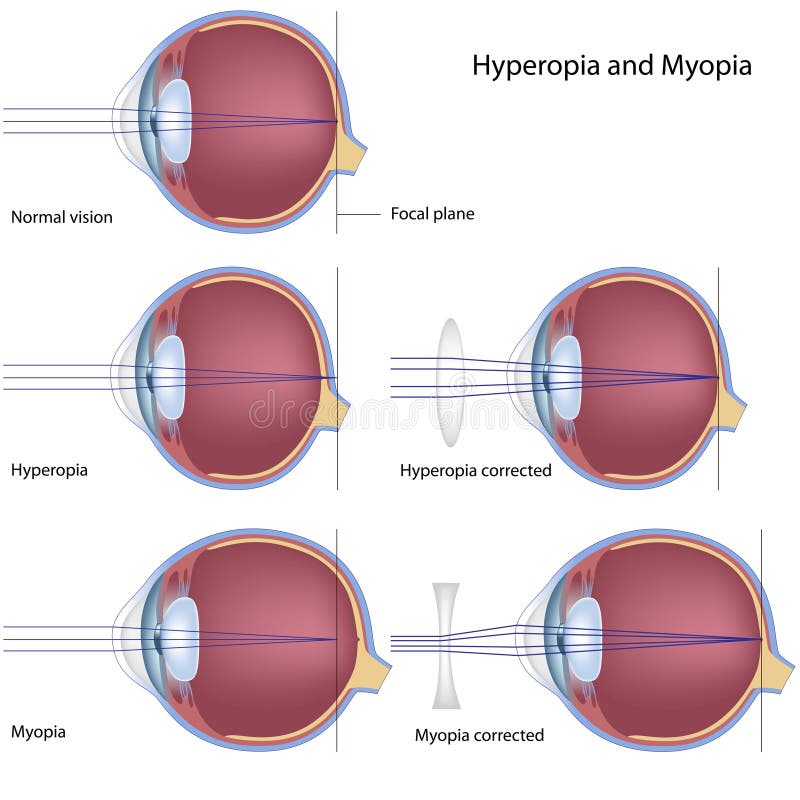 myopia és senilis hyperopia)