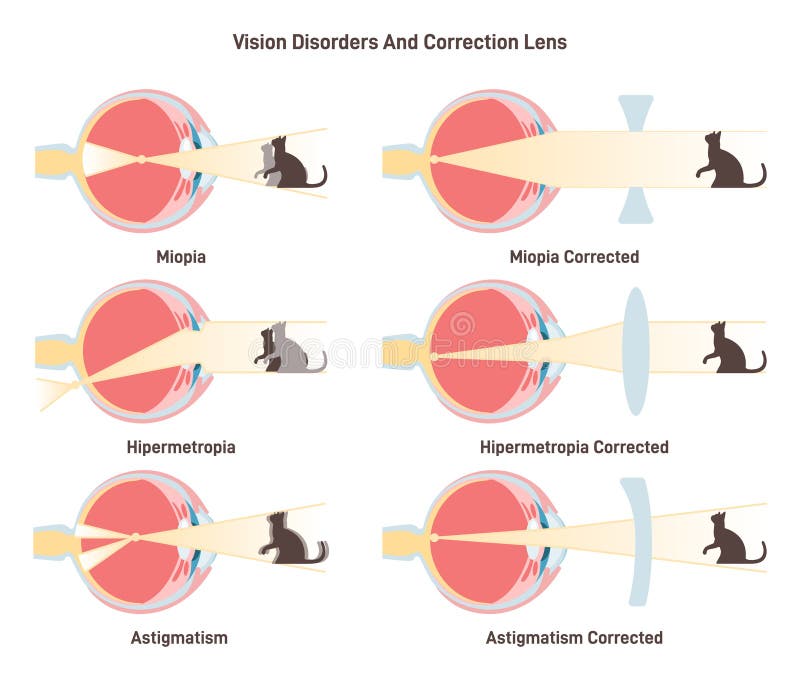 Myopia Hyperopia And Astigmatism Common Vision Disorders And Its myopia-hyperopia-and-astigmatism-common-vision-disorders-and-its