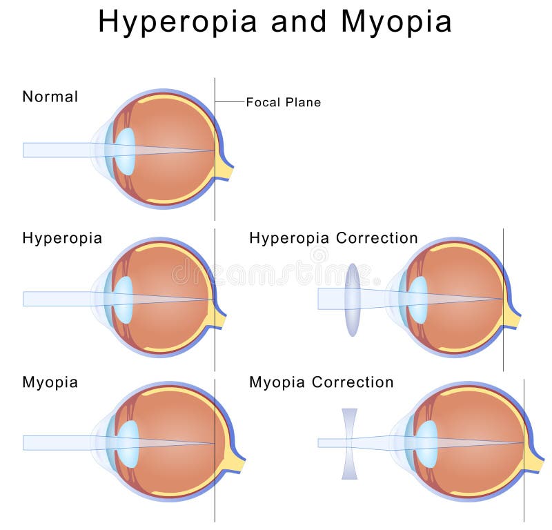 myopia hyperopia diagram