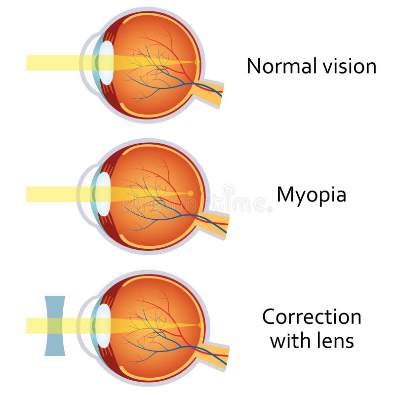 Gyakorlatok a helyreállítása és javítása látást rövidlátás (myopia) az enyhe-közepes