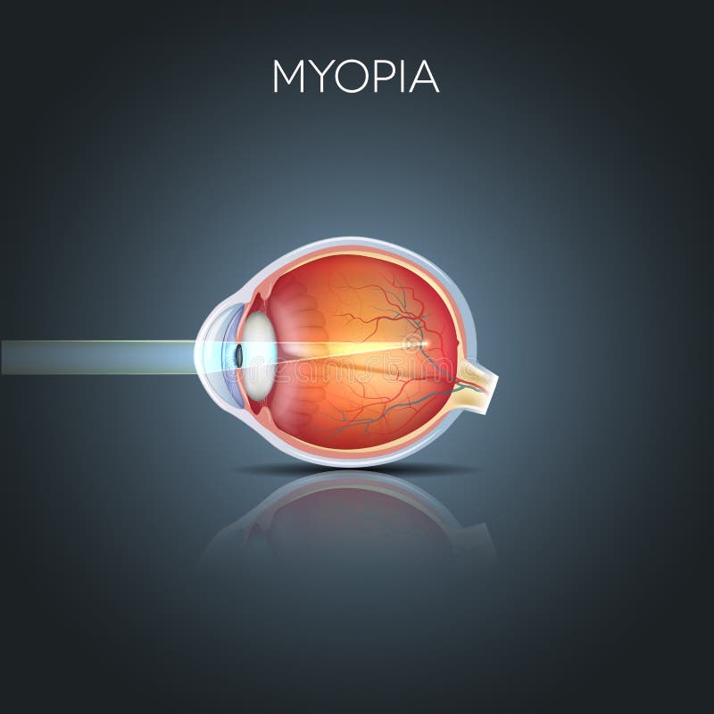 Myopia és hyperopia fizikai jelentés